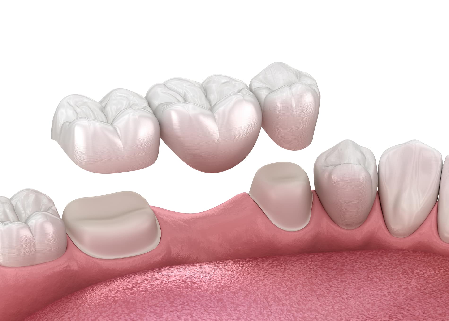 Benefits of dental bridges for a strong and natural smile