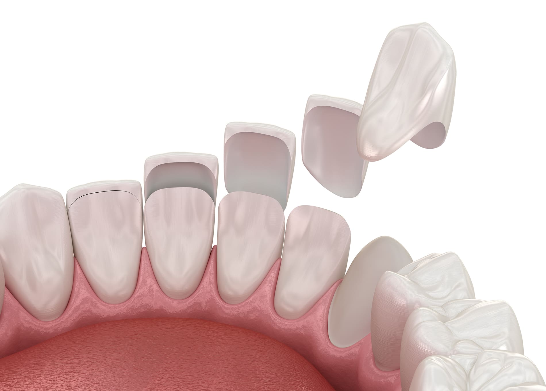 dental crowns for strength, durability, and a natural smile