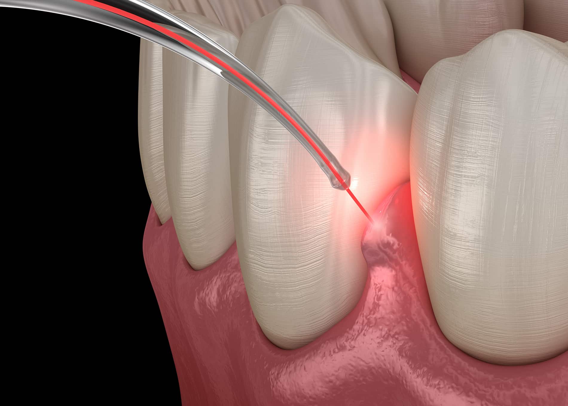 Benefits of treating gum disease for oral health and overall wellness