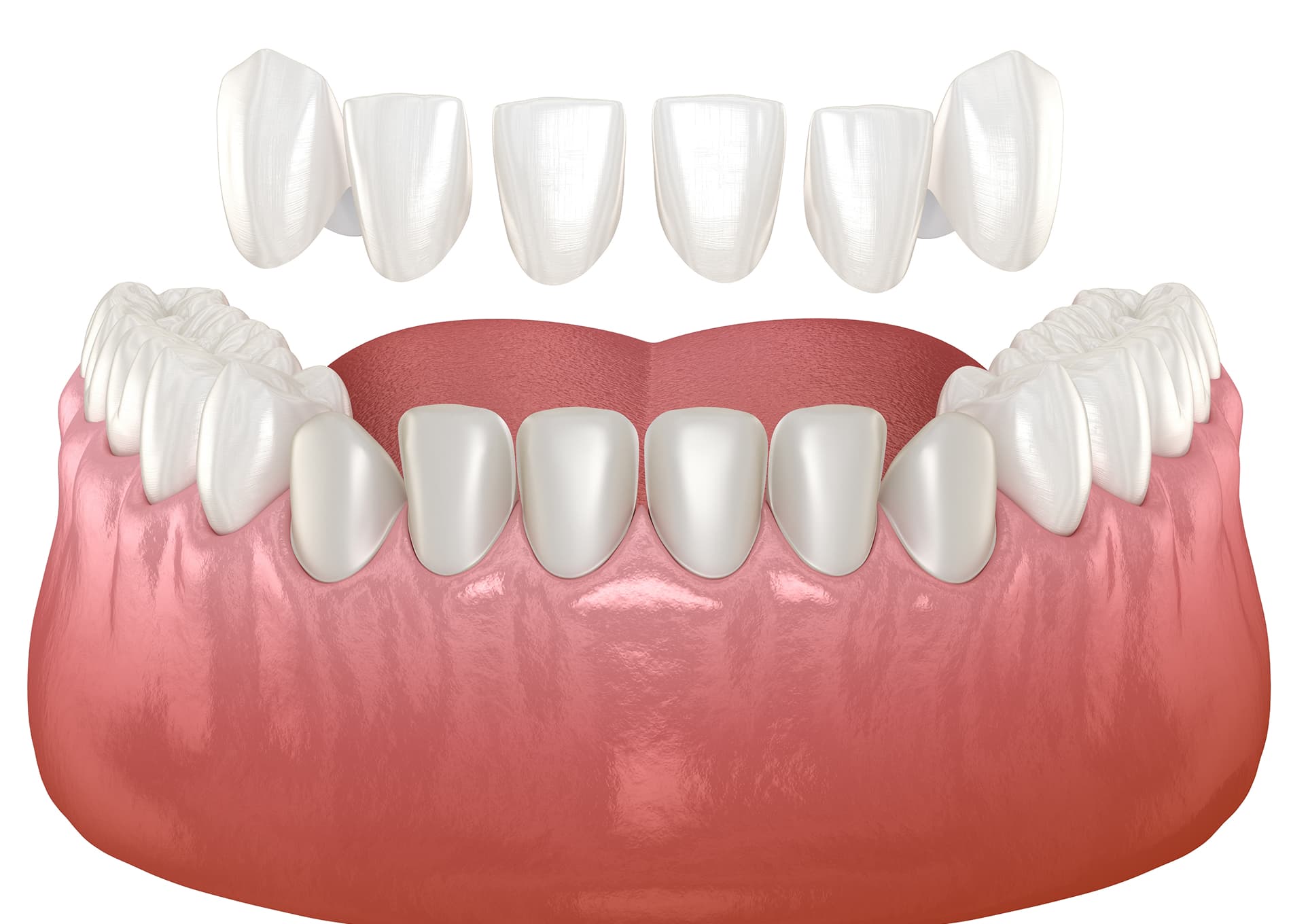Porcelain veneers for a natural, confident smile
