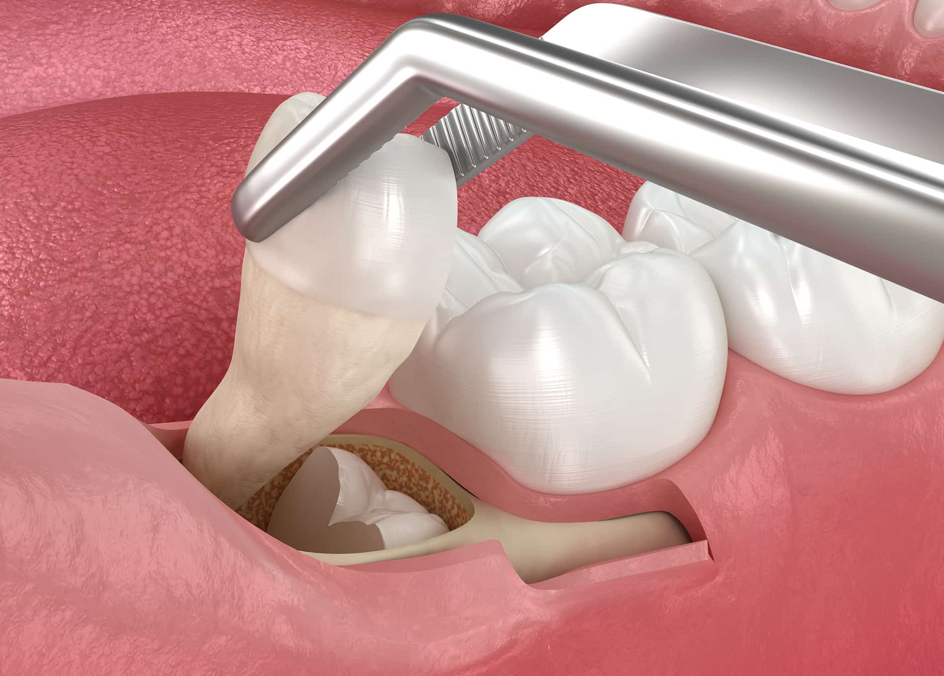 Tooth extraction for decay, injury, or orthodontic needs